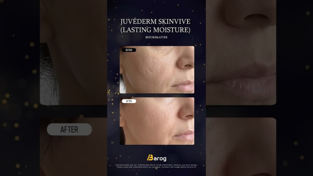 [Gangnam Clinic Seoul: Juvederm SkinVive Before & After✨]