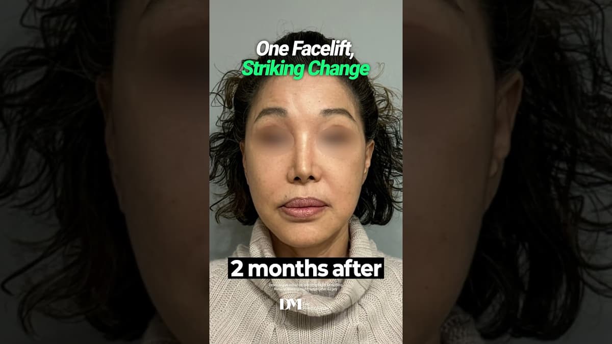 A facelift doesn't just tighten the skin #fyp #trend #viralshorts #facelift #necklift #smaslifting