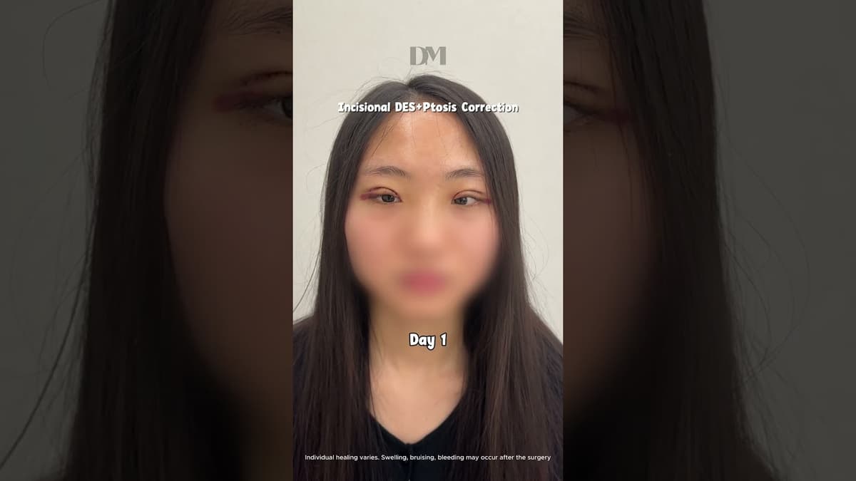 Bet cannot be any natural than this  #seoul #korea #eyesurgerykorea #fyp #trend #viral #kbeauty #lol