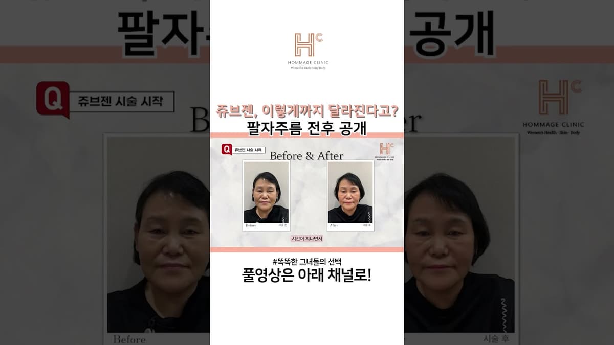 쥬브젠, 이렇게까지 달라진다고?! 팔자주름 전후 공개