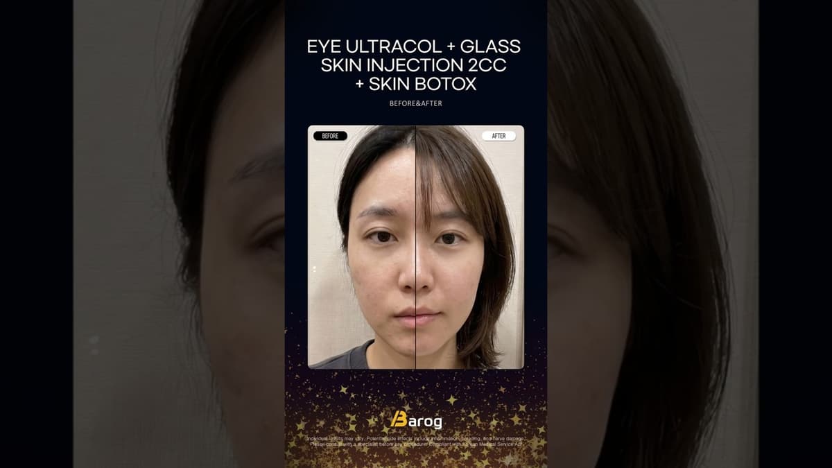 [Clinique Gangnam Séoul : UltraCol Oculaire + Injection Peau de Verre 2cc + Botox Cutané Avant/Après ✨]