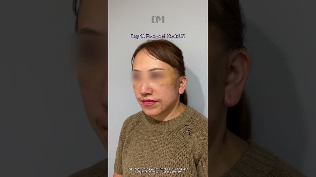 ¿Cómo es el proceso de la cirugía de estiramiento facial? #fyp #tendencia #estiramientofacial #estiramientodecuello #viral #rejuvenecimiento