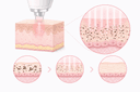 레이저토닝·피코토닝·IPL, 내 색소엔 뭐가 맞을까요?