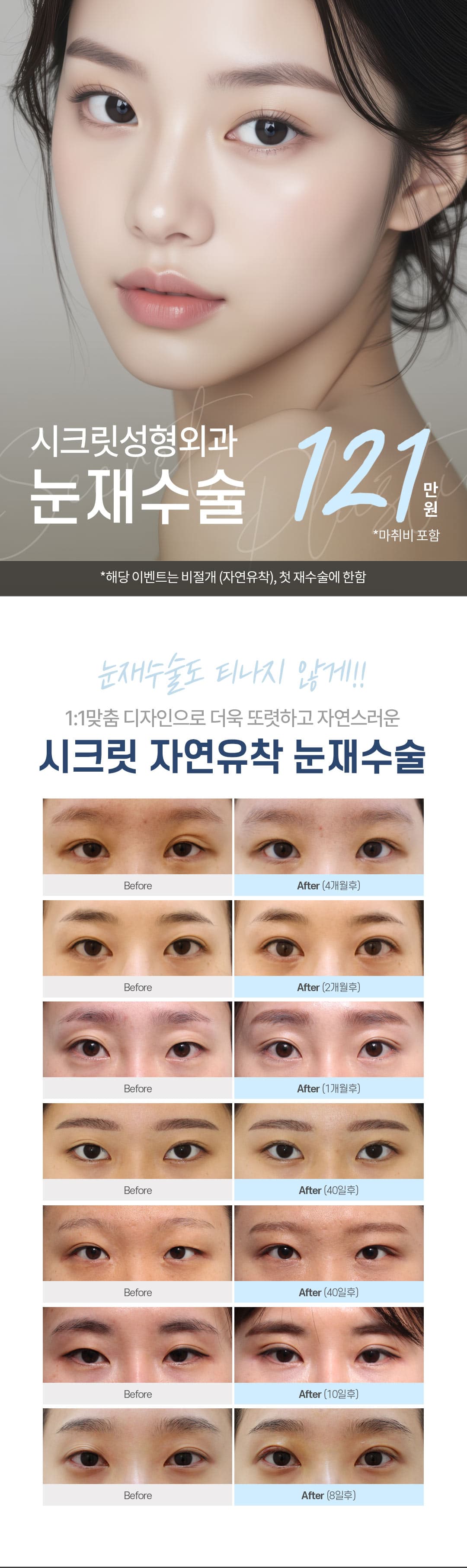 시크릿 눈재수술 1
