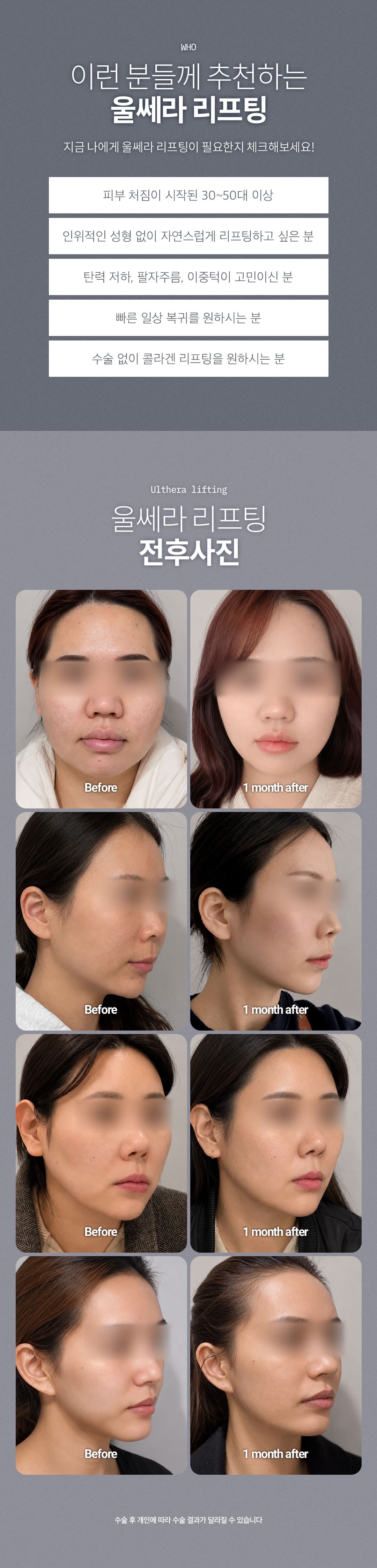 DM Ulthera 300 iniezioni, eseguite direttamente dal responsabile 원장, trattamento del sonno disponibile 3