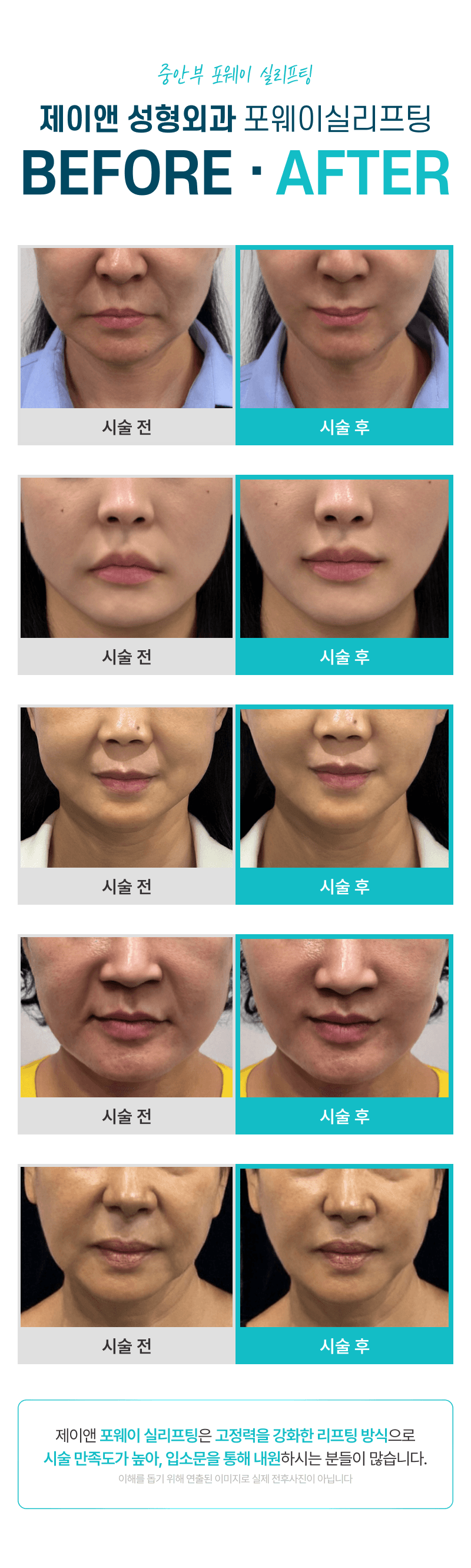 Mid-face Thread Lift - Four-way Thread Lift that lifts 4 times with just a single line 4