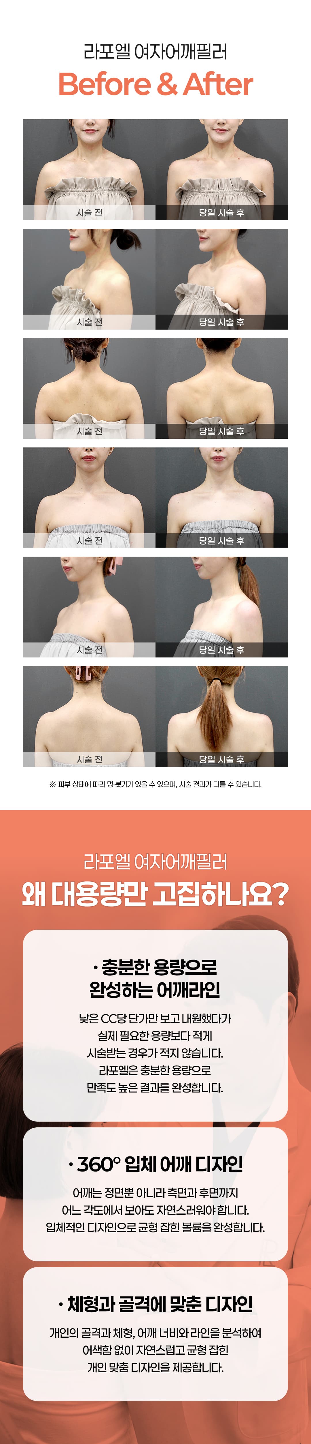 대용량 여자어깨필러 & 쇄골필러 - 여성스러운 직각어깨와 쇄골라인을 선사합니다 이주형 대표원장, 라포엘의원 3