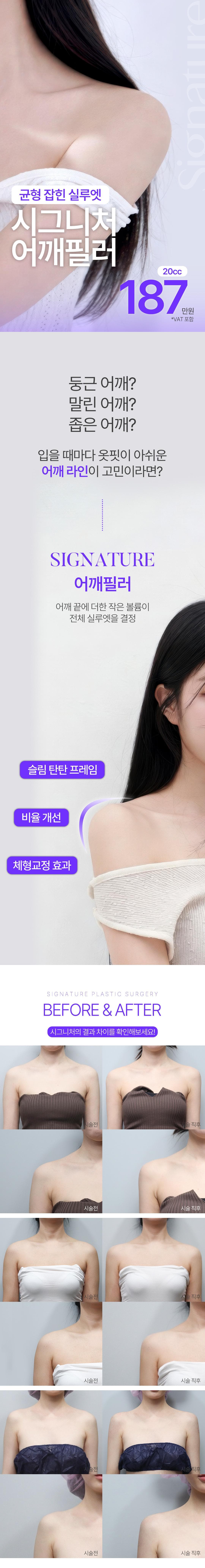 직각여리핏 어깨필러 20cc 1