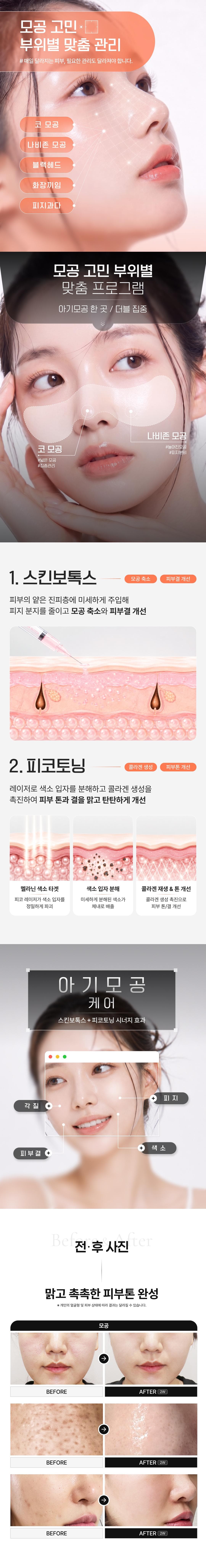 코,나비존 집중관리 아기모공 이벤트 4