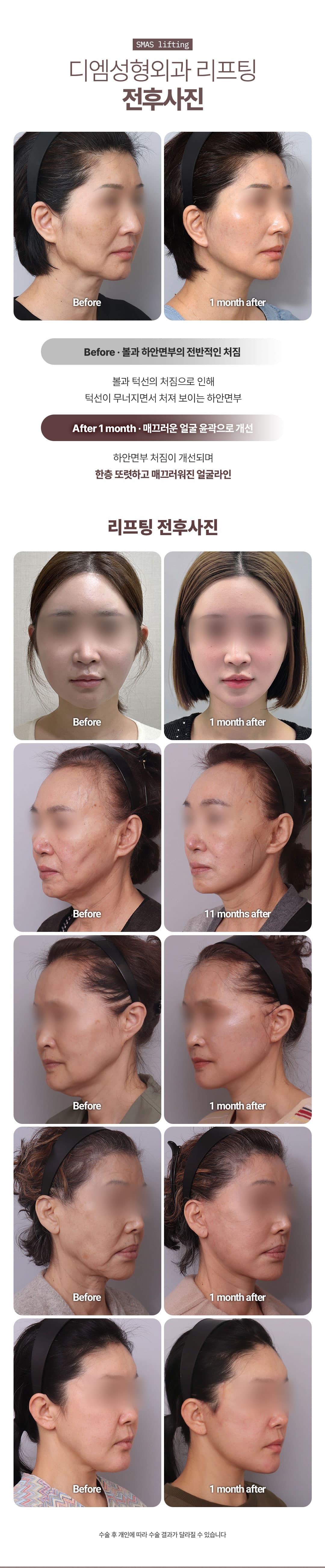 Ketua Pengarah_SMAS Facelift_Termasuk Leher Lift 3