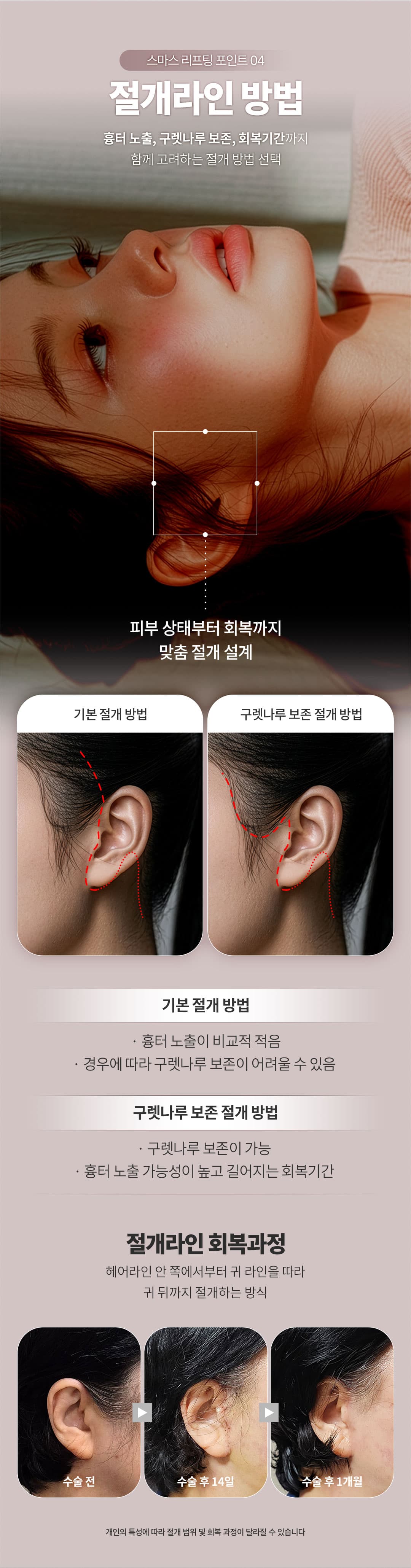 Ketua Pengarah_SMAS Facelift_Termasuk Leher Lift 6