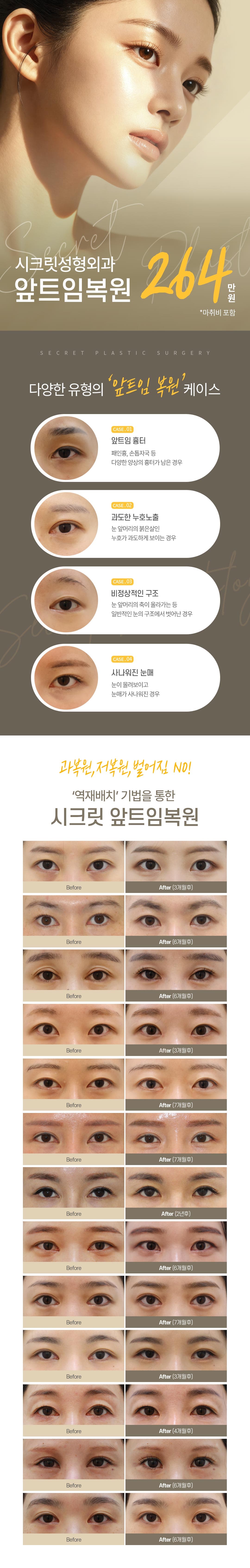시크릿 앞트임복원 1