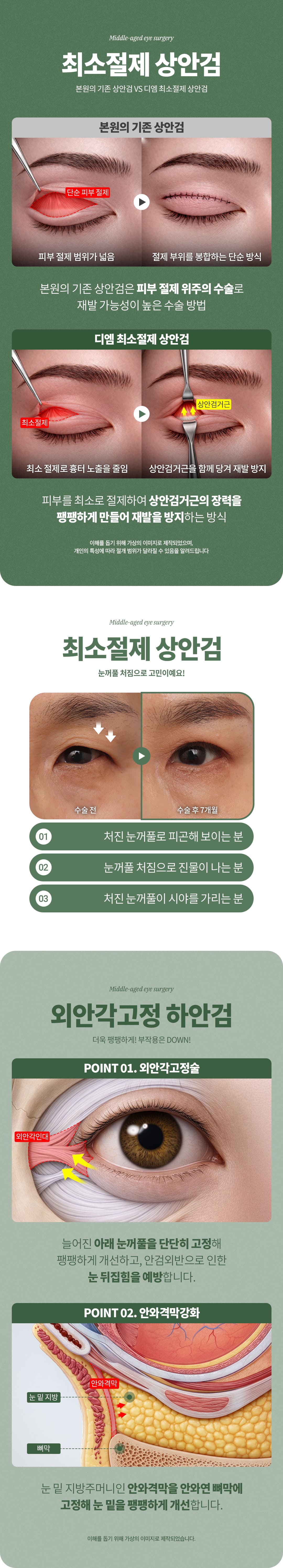 Cirugía ocular para adultos de mediana edad_Elevación de cejas_Blefaroplastia superior_Blefaroplastia inferior_Ptosis 3