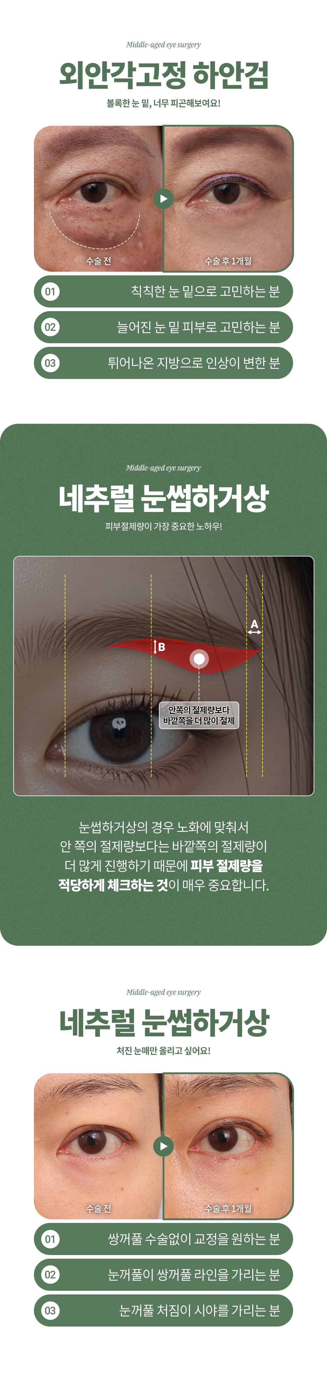 Cirugía ocular para adultos de mediana edad_Elevación de cejas_Blefaroplastia superior_Blefaroplastia inferior_Ptosis 4