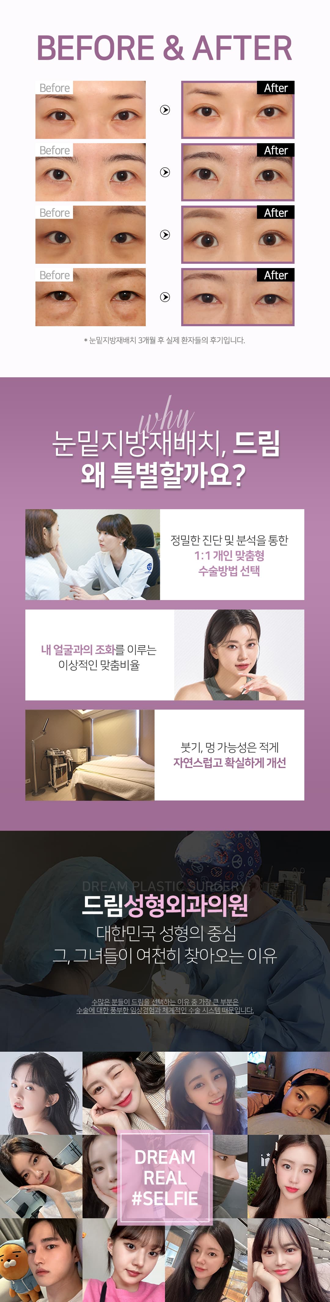 드림 눈밑지방재배치 2
