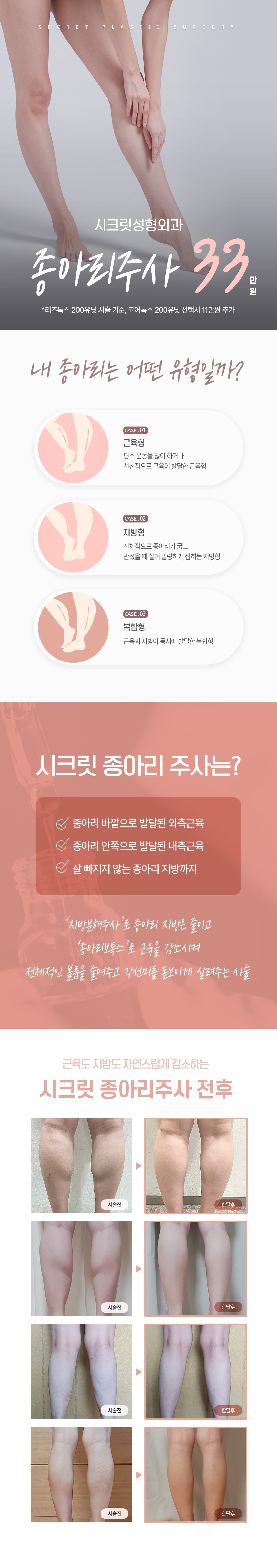 시크릿 종아리주사, 종아리보톡스&종아리지방분해주사 1