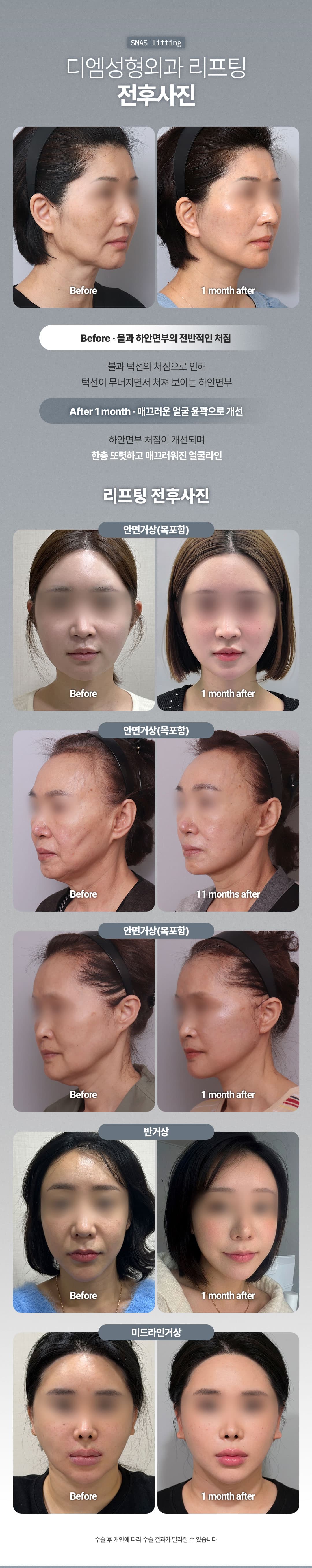 Director General_SMAS Mini Lifting, Semilifting, Lifting de línea media, Lifting facial 3