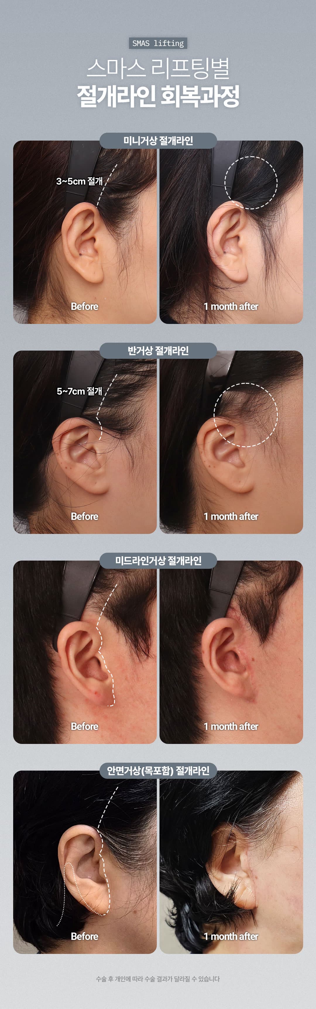 Director General_SMAS Mini Lifting, Semilifting, Lifting de línea media, Lifting facial 6