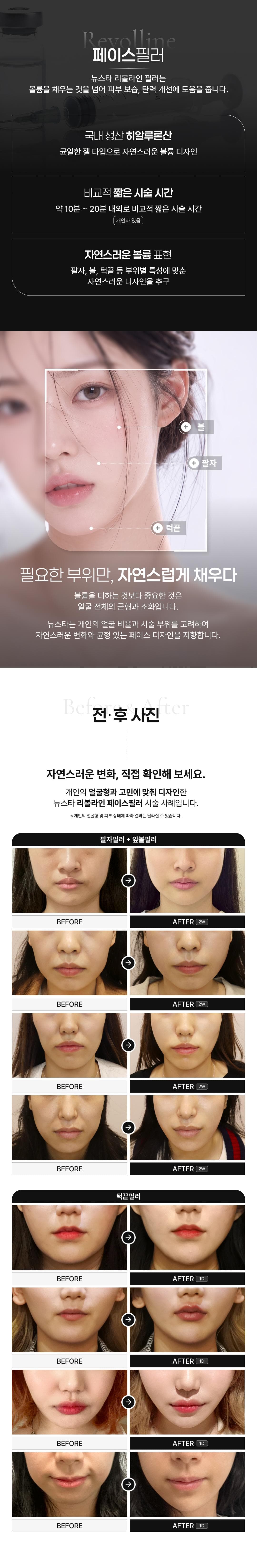 팔자, 볼, 턱 맞춤 페이스필러 첫방문 이벤트 2