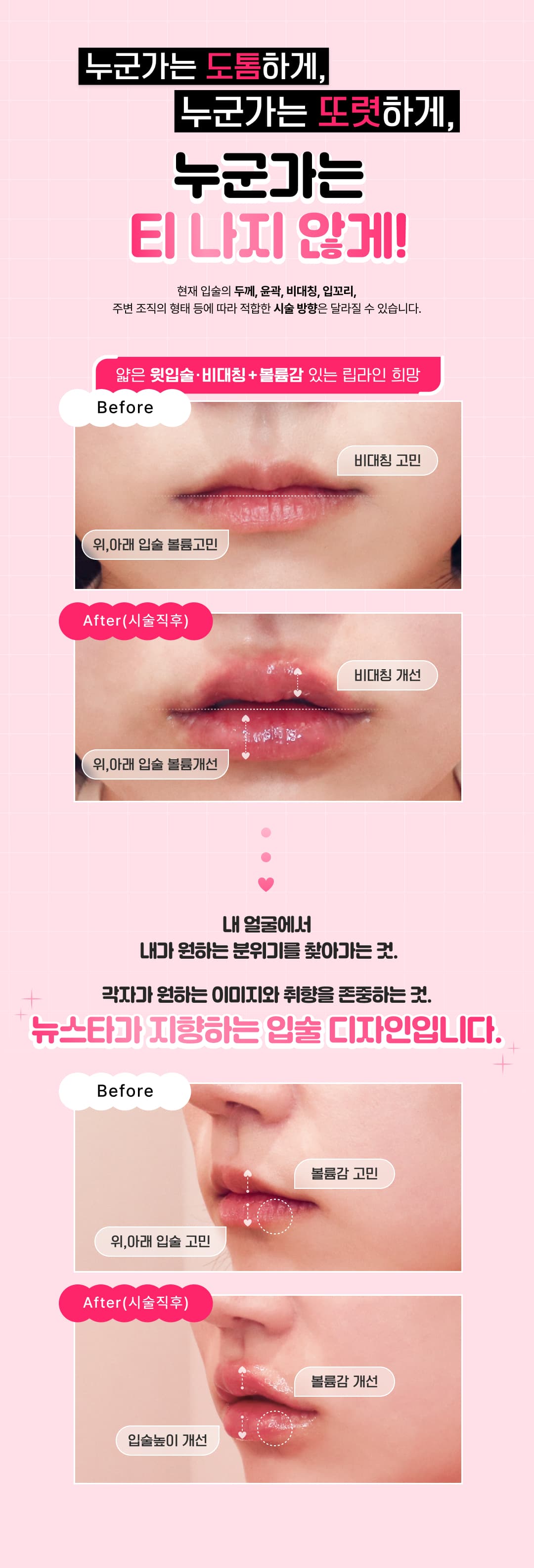 Newstar Lippenfiller, Mundwinkelfiller, Botox für die Mundwinkel, Botox zur Philtrumreduktion 6