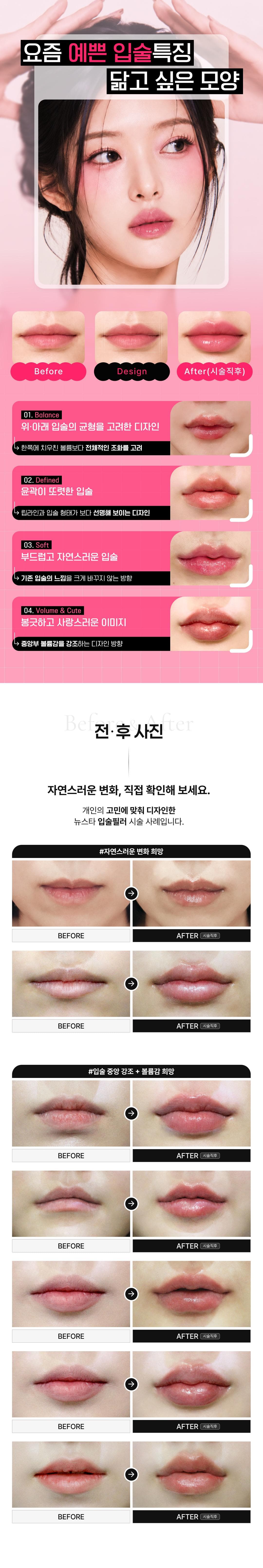 Newstar Lippenfiller, Mundwinkelfiller, Botox für die Mundwinkel, Botox zur Philtrumreduktion 7