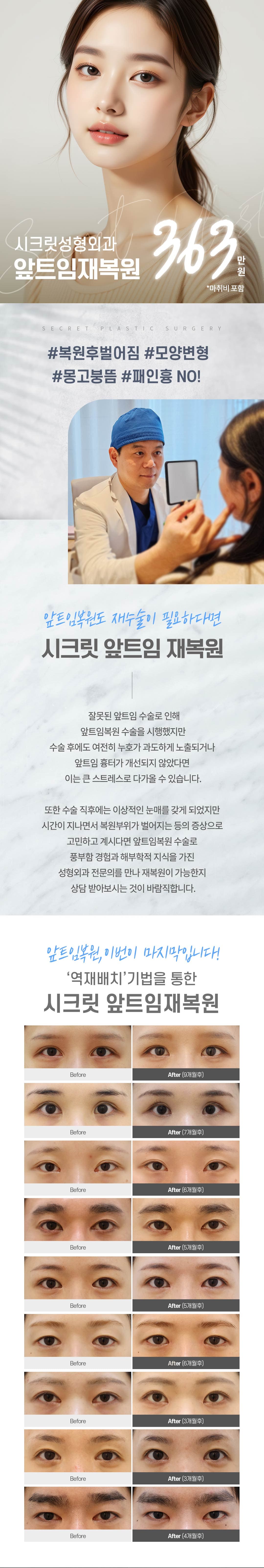 시크릿 앞트임 재복원 1