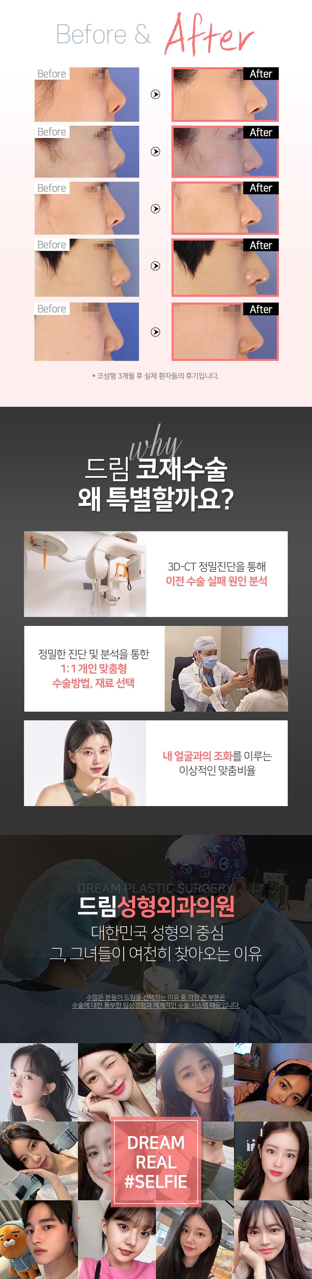 드림 코재수술 첫수술도 끝수술도 코성형은 드림성형외과 2