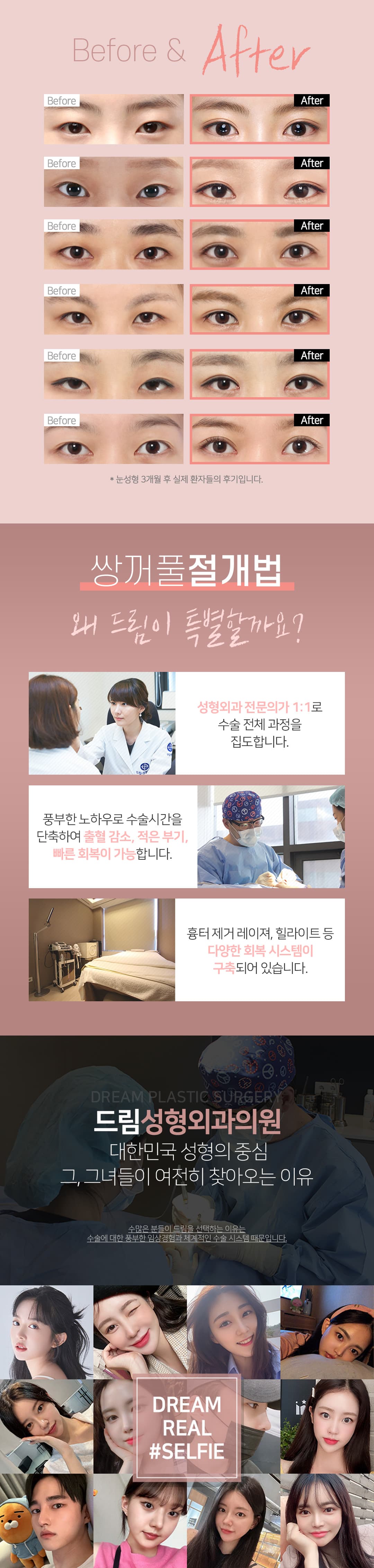 드림 절개 쌍꺼풀 2