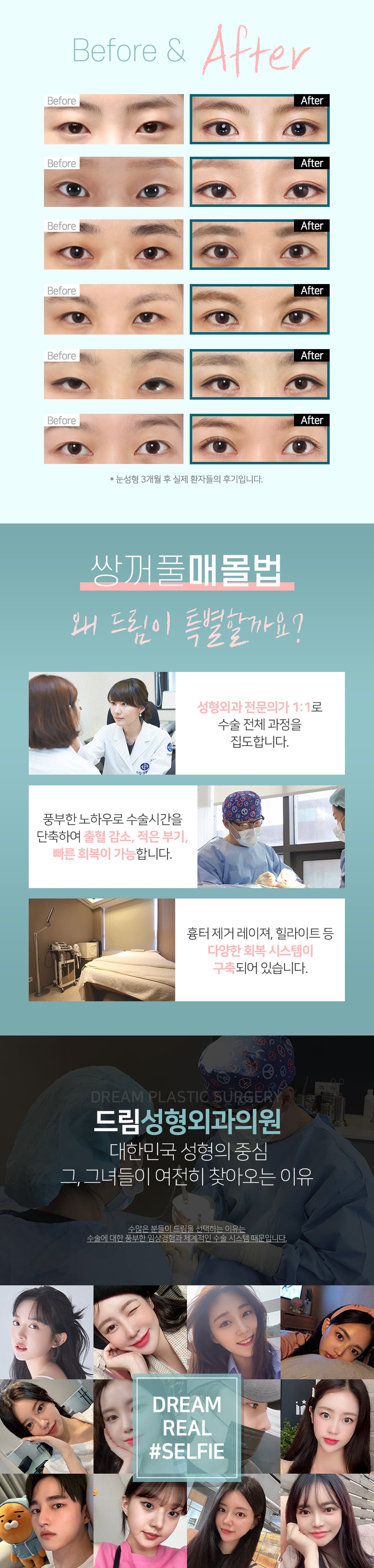 드림 매몰 쌍꺼풀 2