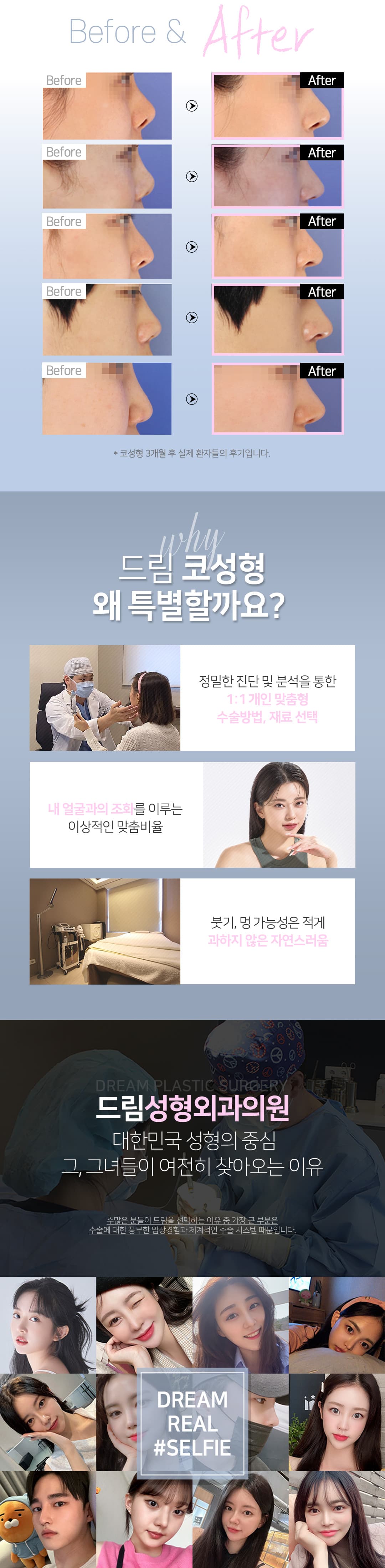 드림 코성형 유형별 맞춤코성형 3