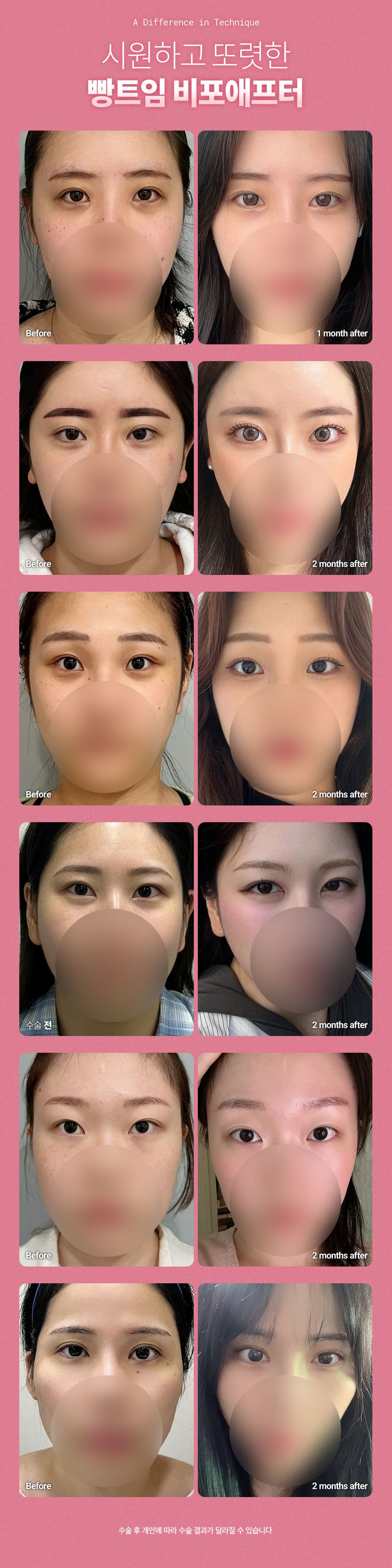 DM_Keine zusätzlichen Kosten für Lidschnitte, Brustschnitte, Frontschnitte, Rückenschnitte, Oberer Schnitt, Unterer Schnitt, Rücken-Unterer Schnitt 6