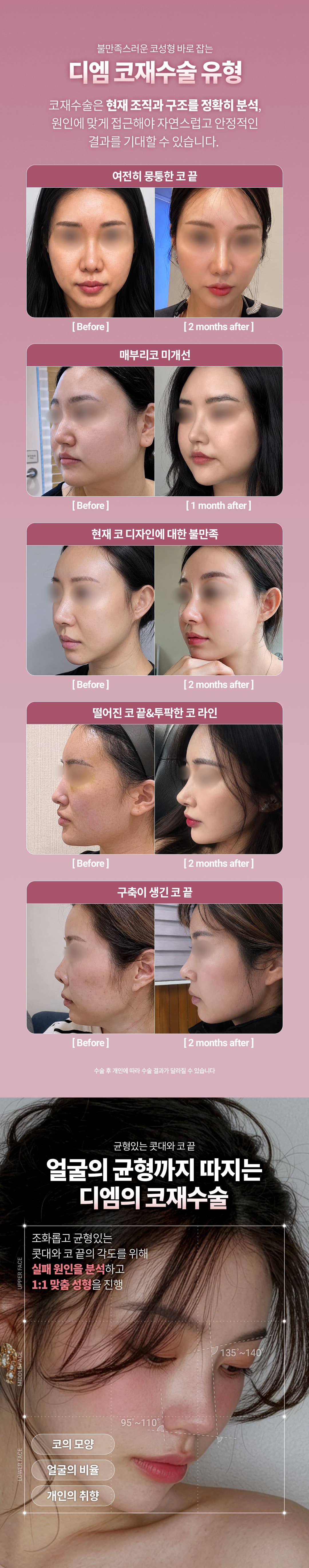 DM Rhinoplasty Revision 2