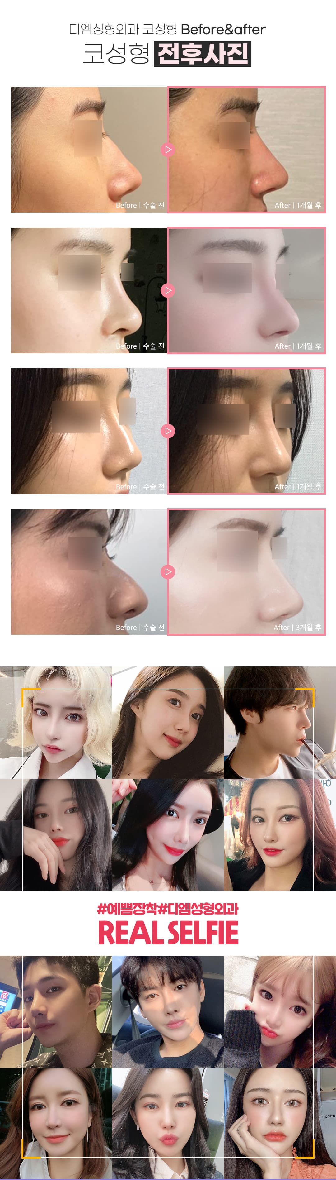 DM-Rhinoplastik-Revision 4