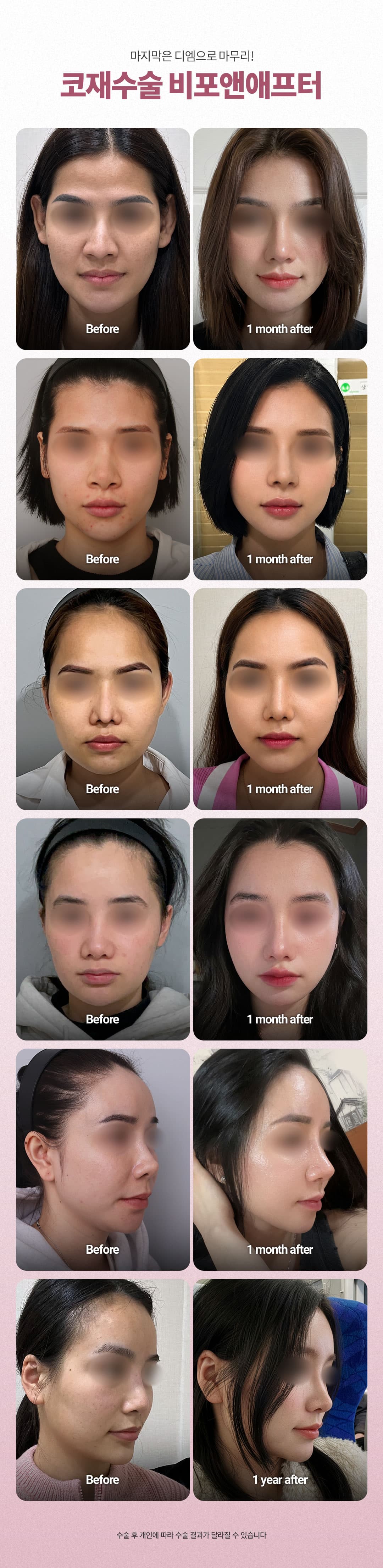 DM Rhinoplasty Revision 5