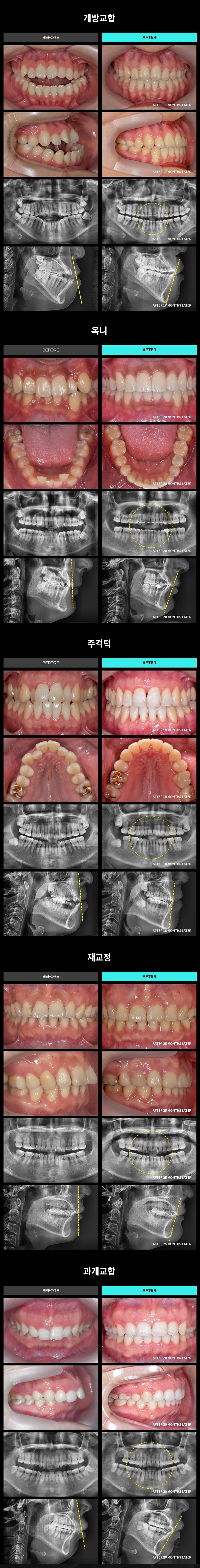 Paiement échelonné possible pour les appareils orthodontiques Invisalign selon le nombre d'or 2