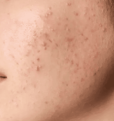 청주여드름치료 잘하는 곳 후기 1