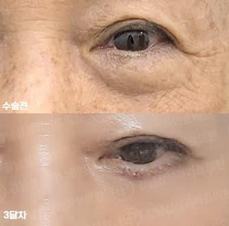 40대 50대 눈밑 하안검수술 흉터, 회복기간 3달차 전후 1