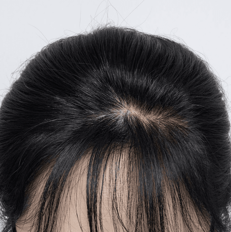 smp두피문신잘하는곳에서 가르마 비어 보이던거 드디어 탈출했어요 ㅎㅎ (전후 사진있음) 1