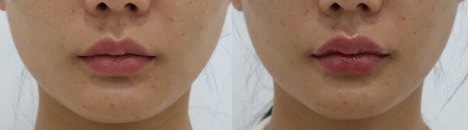 대구입술필러 잘하는곳 다른가요? 1