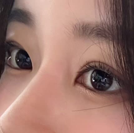눈밑지방재배치수술후 붓기, 통증, 음주, 흡연 관리 알려드려요 1