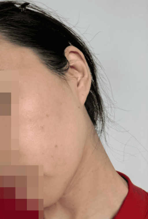 청주흑자제거 해보신 분 후기 좀요 1