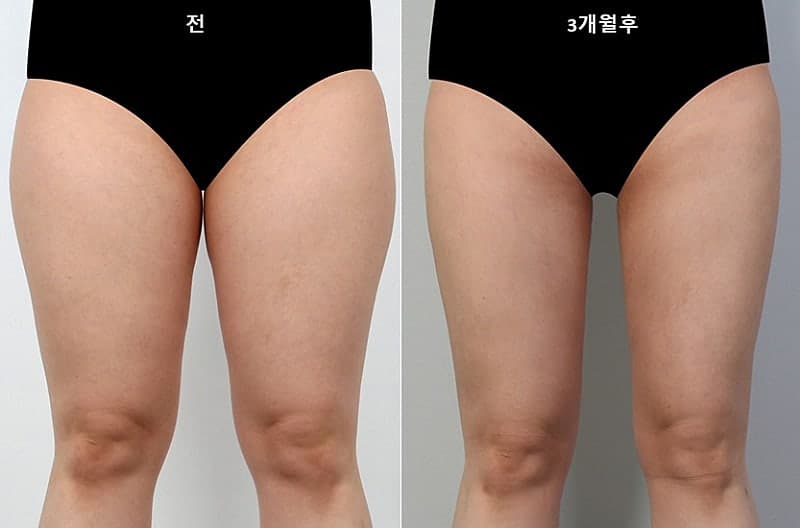 허벅지지방흡입가격 부담 줄인 지방추출주사 세달차 후기 전후 2