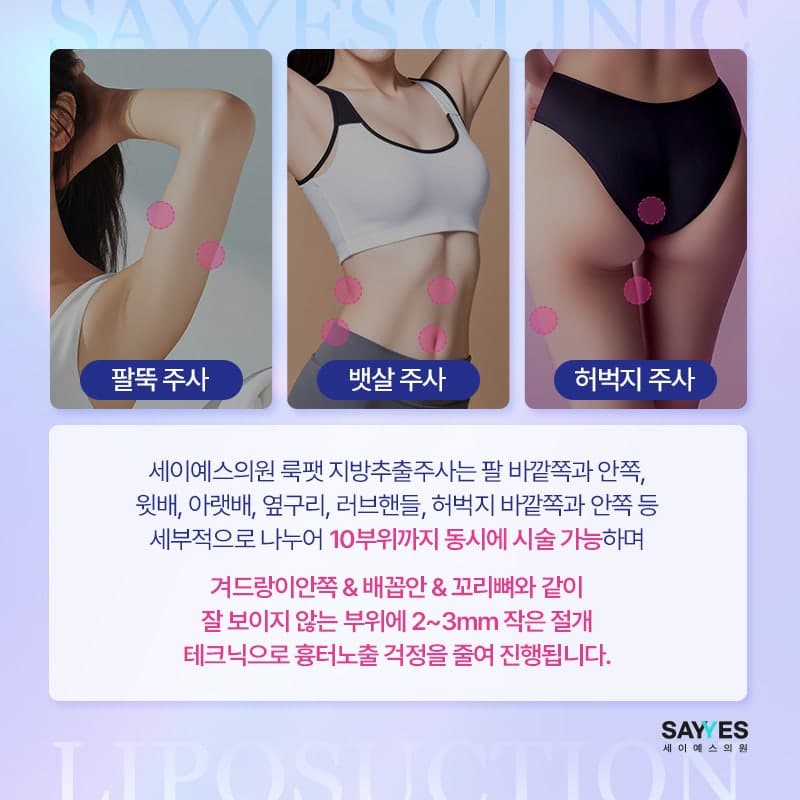 허벅지지방흡입가격 부담 줄인 지방추출주사 세달차 후기 전후 5
