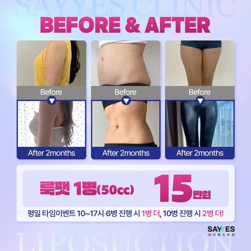 허벅지지방흡입가격 부담 줄인 지방추출주사 세달차 후기 전후 7