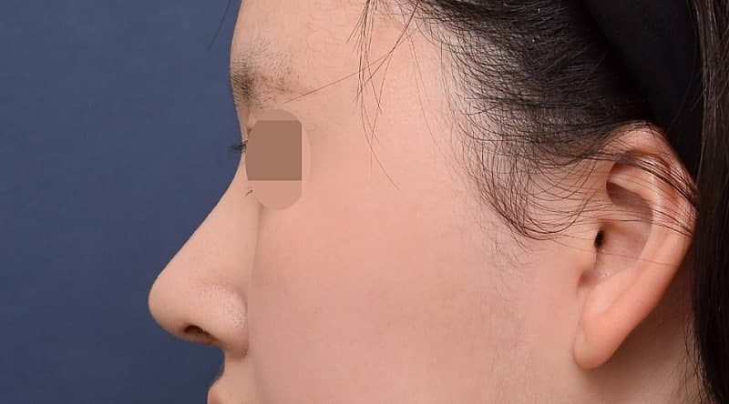 코성형잘하는곳 알아보다 오브제 박시현원장님한테 자련코 만났어요! (ft.무보형물) 2