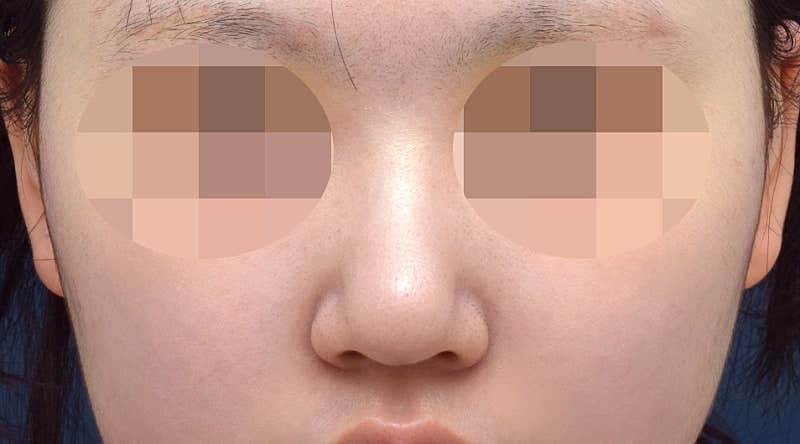 코성형잘하는곳 알아보다 오브제 박시현원장님한테 자련코 만났어요! (ft.무보형물) 3