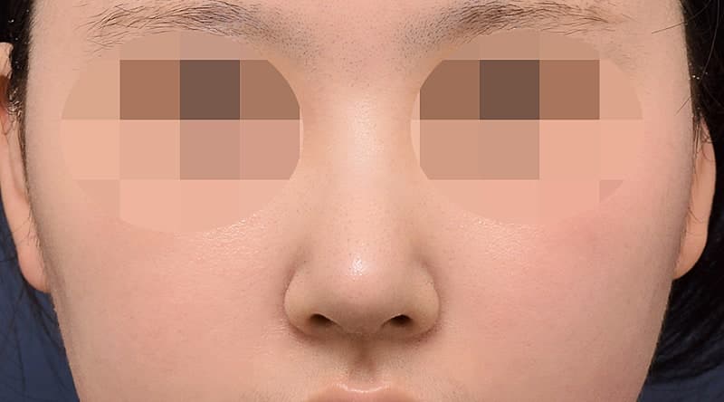 코성형잘하는곳 알아보다 오브제 박시현원장님한테 자련코 만났어요! (ft.무보형물) 4