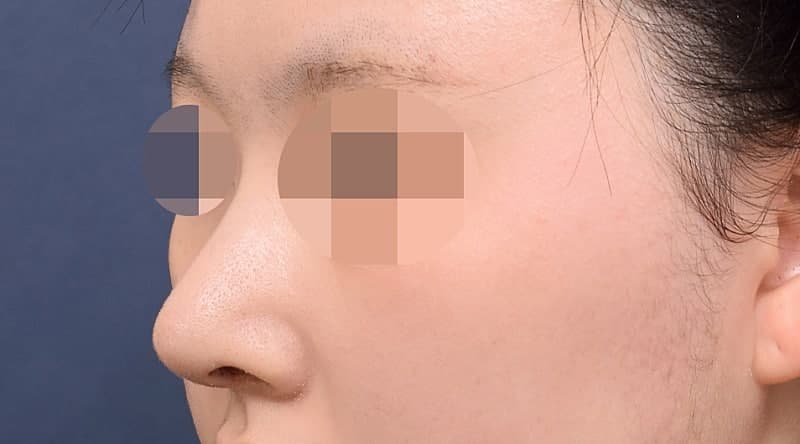 코성형잘하는곳 알아보다 오브제 박시현원장님한테 자련코 만났어요! (ft.무보형물) 5
