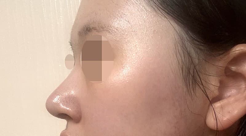 코성형잘하는곳 알아보다 오브제 박시현원장님한테 자련코 만났어요! (ft.무보형물) 6