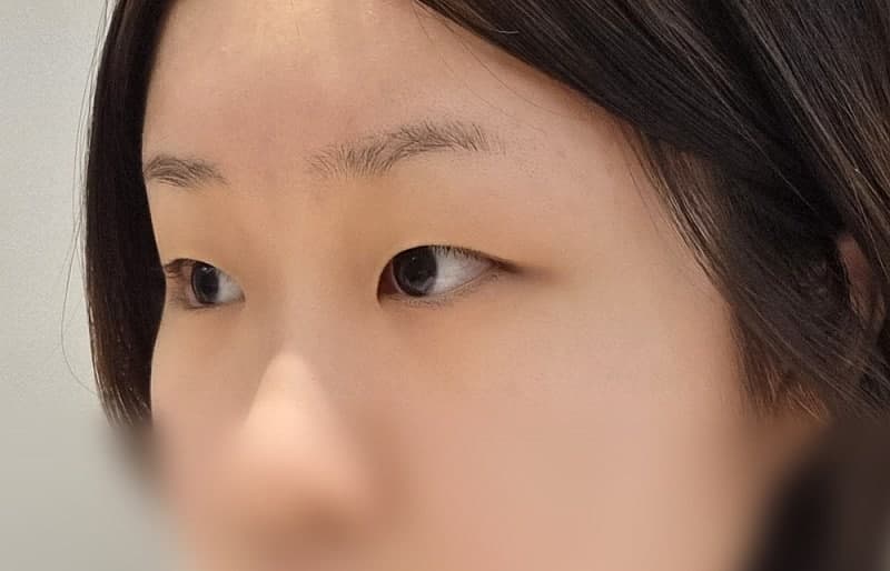 비절개눈매교정으로 무쌍 탈출한 쌍트후기 남겨용💛오브제 김현조원장님💛 2